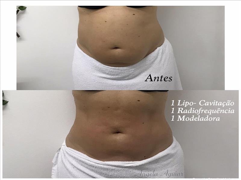 MODELADORA + LIPOCAVITAÇÃO + RADIOFREQUÊNCIA