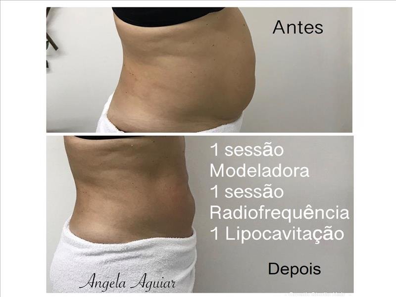MODELADORA + LIPOCAVITAÇÃO + RADIOFREQUÊNCIA