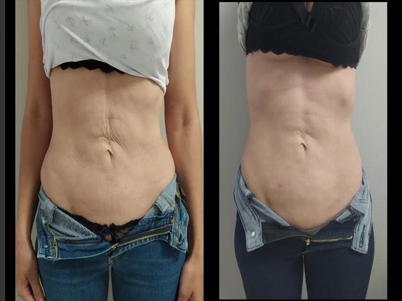 CRIOFREQUÊNCIA – ELIMINE A FLACIDEZ com o MENOR PREÇO EXCLUSIVO BLACK DINDA!