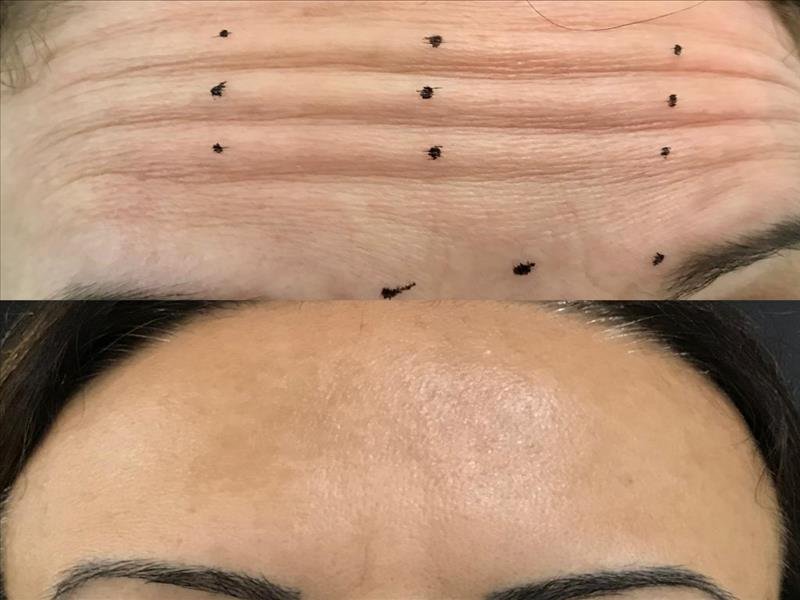 Harmonização facial - Botox e preenchimento labial