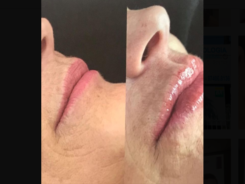 Harmonização facial - Botox e preenchimento labial