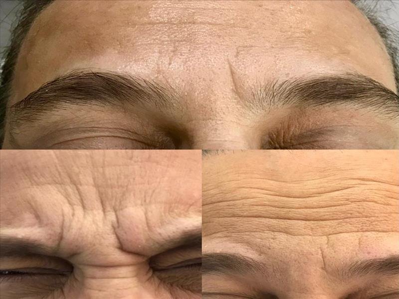 Harmonização facial - Botox e preenchimento labial