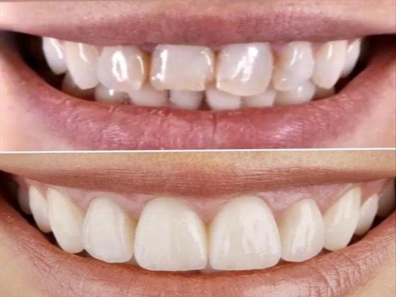 Estética dental - Facetas de porcelana e clareamento