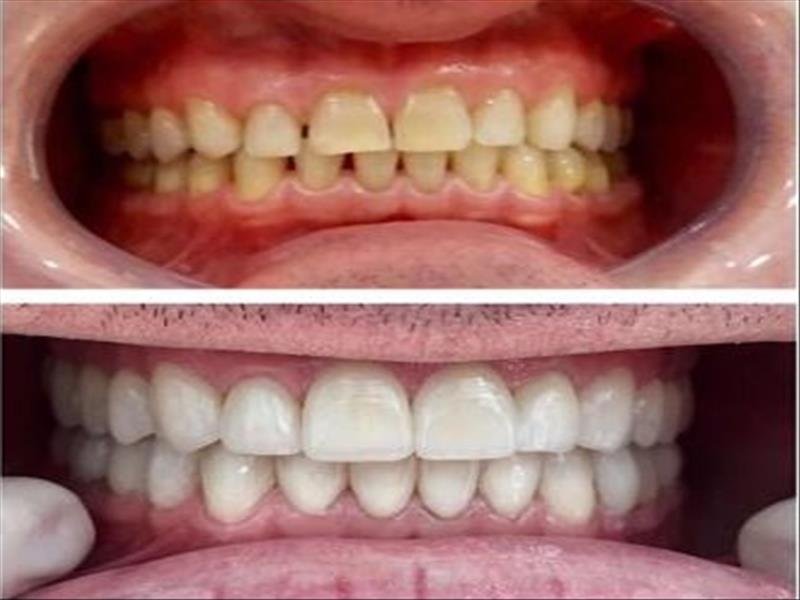 Estética dental - Facetas de porcelana, clareamento e o menor preço exclusivo Dinda Shop